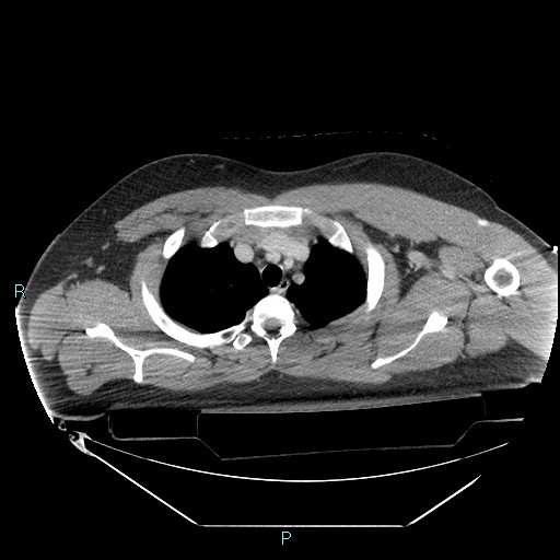 File:Bronchial carcinoid tumor (Radiopaedia 78272-90870 C 29).jpg