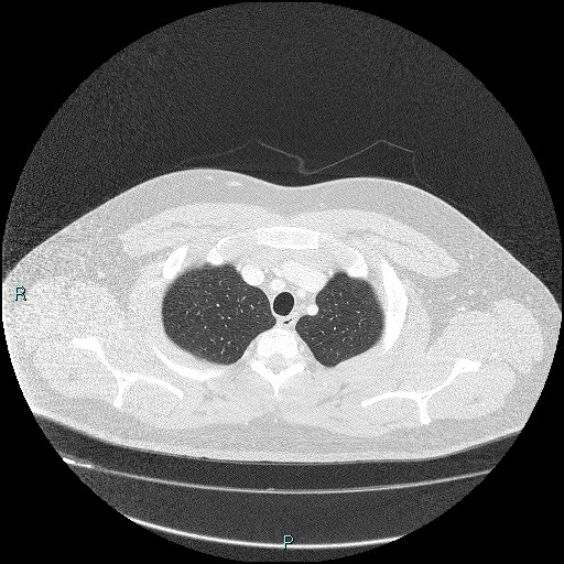 Bronchial carcinoid tumor (Radiopaedia 78272-90875 Axial lung window 6).jpg
