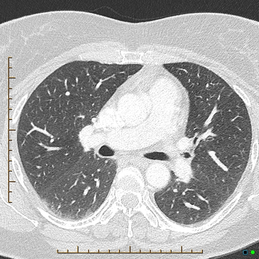 Bronchial diverticula (Radiopaedia 79512-92676 Axial lung window 83).jpg