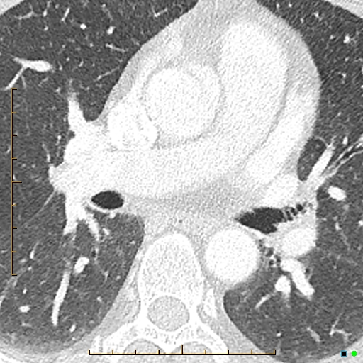 File:Bronchial diverticula (Radiopaedia 79512-92677 Axial lung window 12).jpg