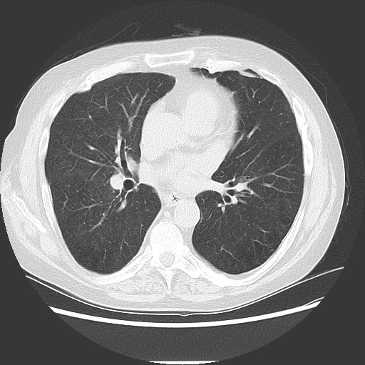 Bronchial stenosis - lung transplant (Radiopaedia 73133-83848 Axial lung window 35).jpg