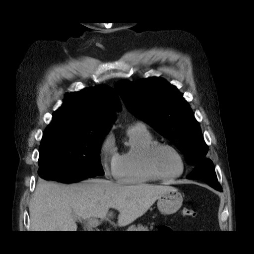 Bronchial stenosis - lung transplant (Radiopaedia 73133-83848 Coronal non-contrast 23).jpg