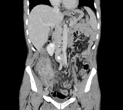 Bronchiectasis in Crohn disease (Radiopaedia 60311-67977 C 35).jpg