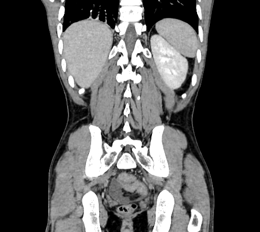 File:Bronchiectasis in Crohn disease (Radiopaedia 60311-67977 C 67).jpg