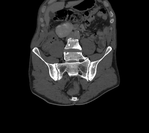 Bronchiectasis in Crohn disease (Radiopaedia 60311-67977 Coronal bone window 24).jpg
