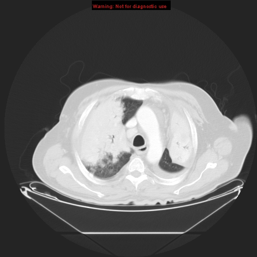 File:Bronchioloalveolar carcinoma (Radiopaedia 9272-9955 Axial lung window 9).jpg