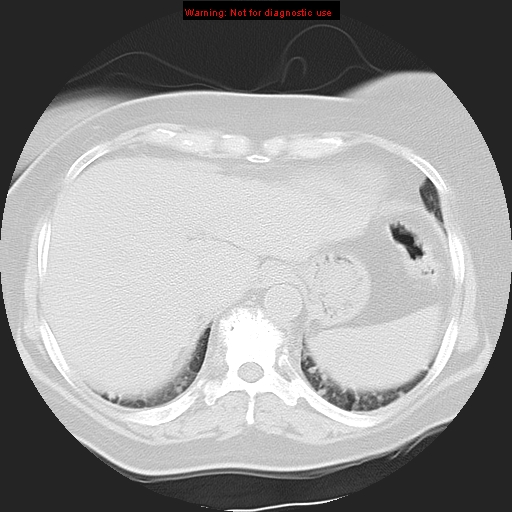 File:Bronchoalveolar carcinoma (Radiopaedia 13224-13233 Axial lung window 37).jpg