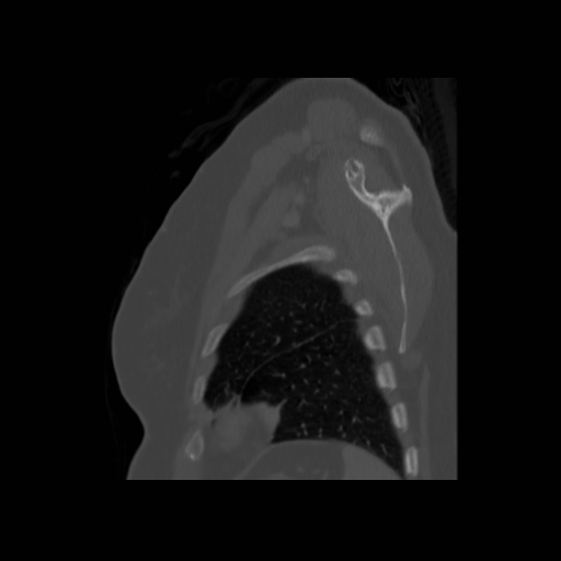 Bronchogenic carcinoma (Radiopaedia 73497-84262 Sagittal bone window 130).jpg
