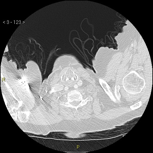 Bronchogenic carcinoma as an incidental finding (Radiopaedia 16453-16130 Axial lung window 123).jpg