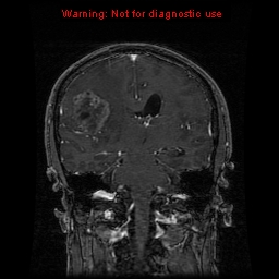 File:Bronchogenic carcinoma brain metastasis (Radiopaedia 9286-9969 Coronal T1 11).jpg