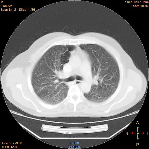 File:Bronchogenic carcinoma with superior vena caval invasion (Radiopaedia 22378-22406 lung window 8).jpg