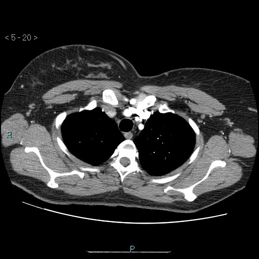 File:Bronchogenic cyst - posterior mediastinal (Radiopaedia 43885-47364 A 11).jpg