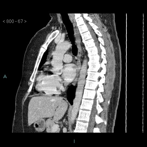 Bronchogenic cyst - posterior mediastinal (Radiopaedia 43885-47364 B 44).jpg