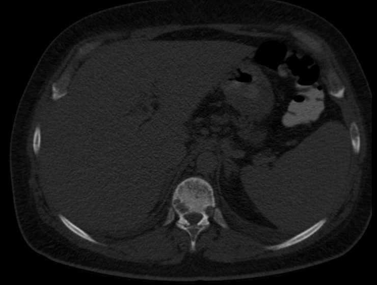 Brown tumors compressing the spinal cord (Radiopaedia 68442-77988 Axial bone window 73).jpg