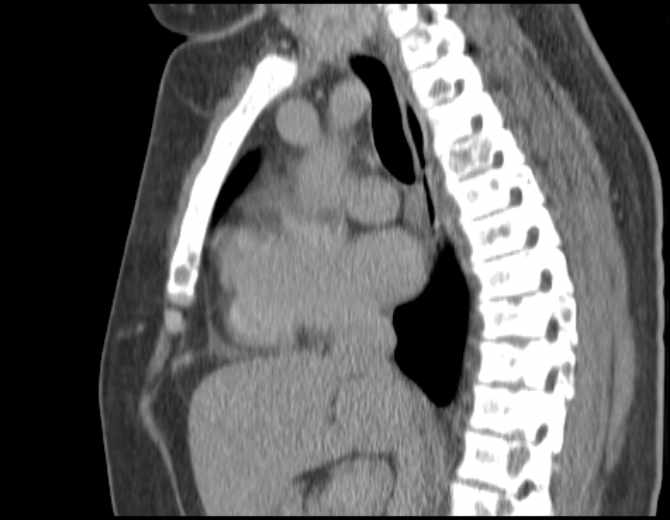 Brown tumors compressing the spinal cord (Radiopaedia 68442-77988 B 29).jpg