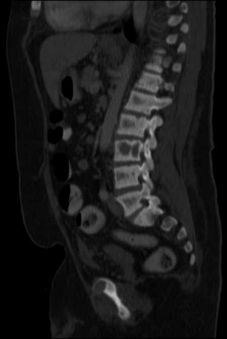 Brown tumors compressing the spinal cord (Radiopaedia 68442-77988 H 32).jpg