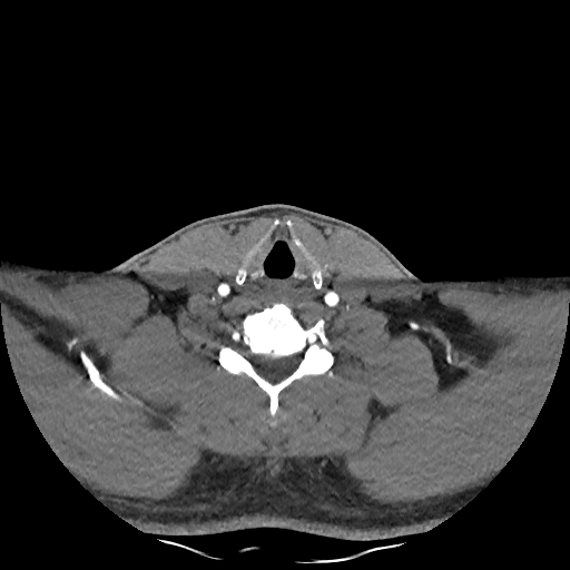 Buccal fat pad arteriovenous malformation (Radiopaedia 70936-81144 D 94).jpg