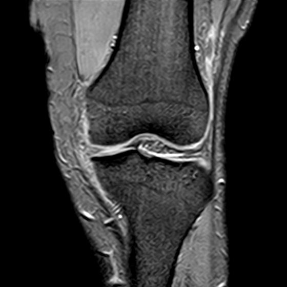 File:Bucket handle tear - medial meniscus (Radiopaedia 29250-29664 B 6).jpg