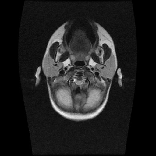 File:Burkitt lymphoma of the orbit. pre and post chemotherapy (Radiopaedia 31214-31930 Axial 17).jpg