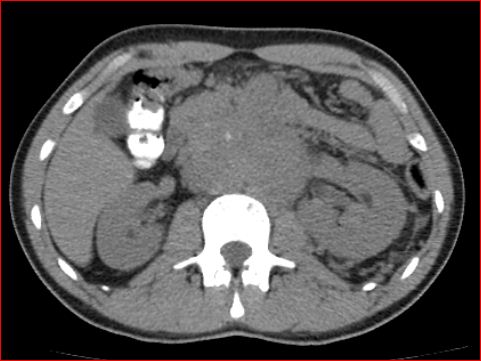 File:Burned-out testicular choriocarcinoma (Radiopaedia 32822-34040 Axial non-contrast 8).jpg