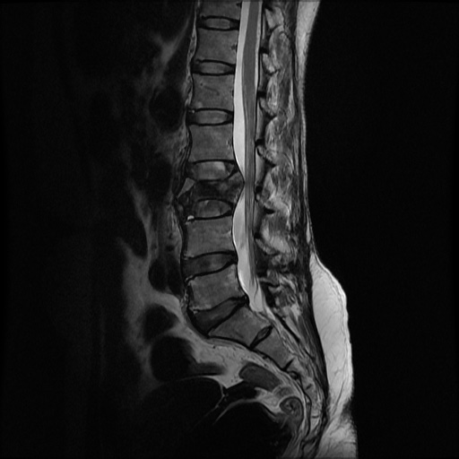 File:Burst fracture - lumbar spine (Radiopaedia 72877-83541 Sagittal T2 5).jpg