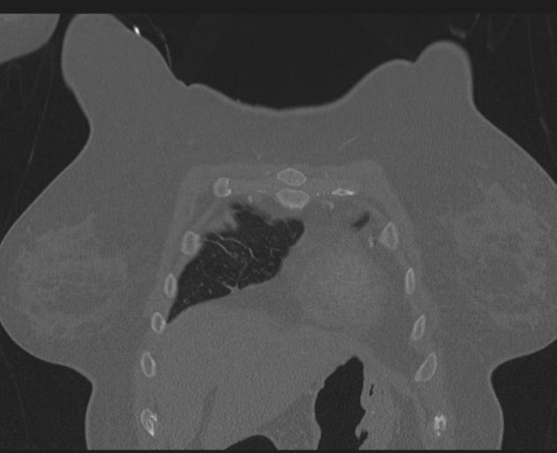 Burst fracture - thoracic spine (Radiopaedia 30238-30865 Coronal bone window 32).jpg