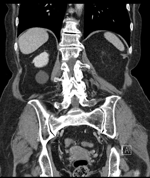 Calcified adrenal glands and Spigelian hernia (Radiopaedia 49741-54988 B 84).jpg