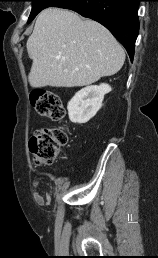 Calcified adrenal glands and Spigelian hernia (Radiopaedia 49741-54988 C 128).jpg