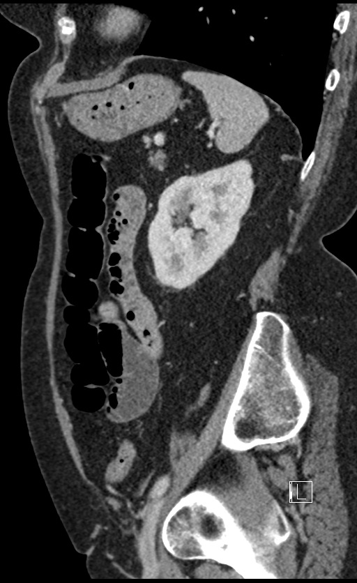 Calcified adrenal glands and Spigelian hernia (Radiopaedia 49741-54988 C 43).jpg