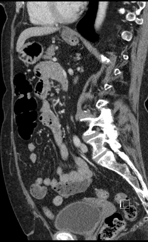 Calcified adrenal glands and Spigelian hernia (Radiopaedia 49741-54988 C 71).jpg