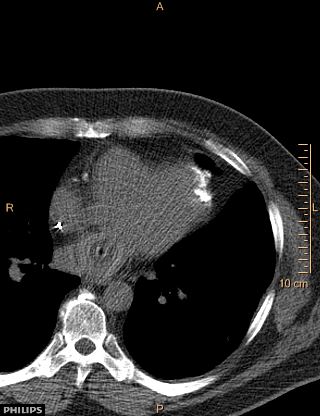 File:Calcified cardiac fibroma (Radiopaedia 39267-41519 Axial non-contrast 7).jpg