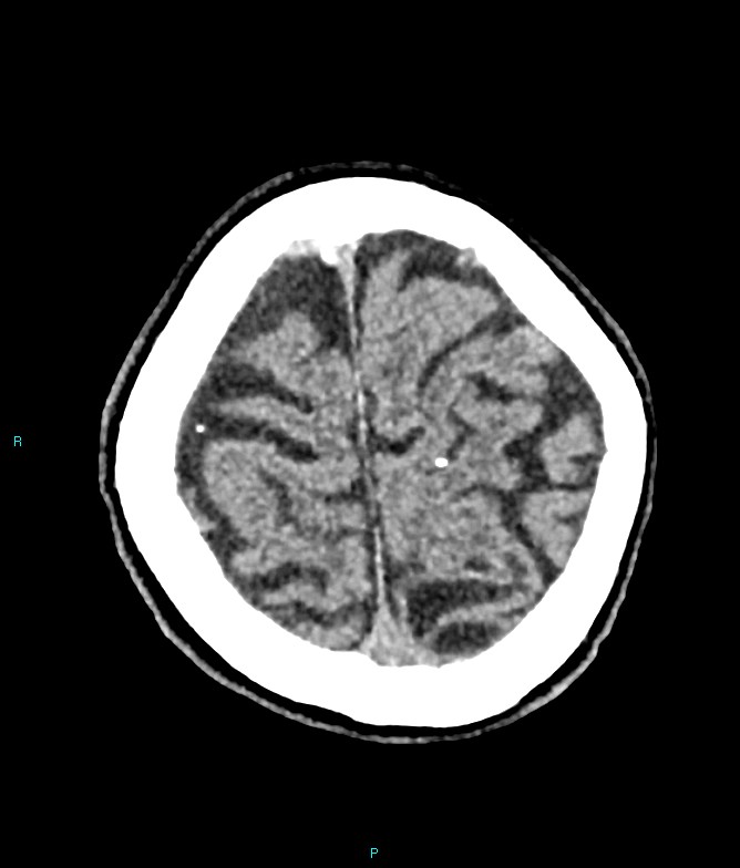 Calcified cerebral emboli from left ventricular thrombus (Radiopaedia 84420-99758 Axial non-contrast 17).jpg