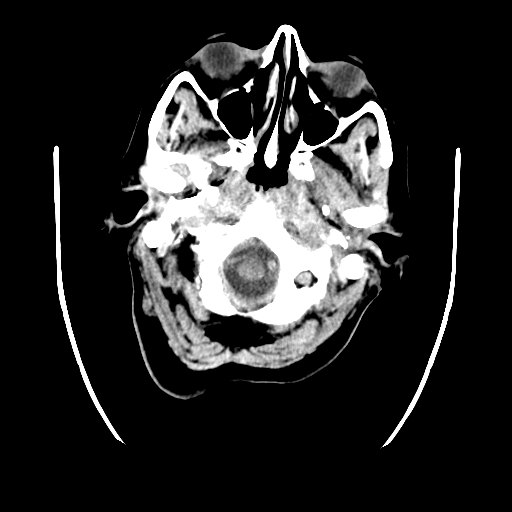 File:Calcified choroid plexus through the foramina of Luschka (Radiopaedia 60483).jpg