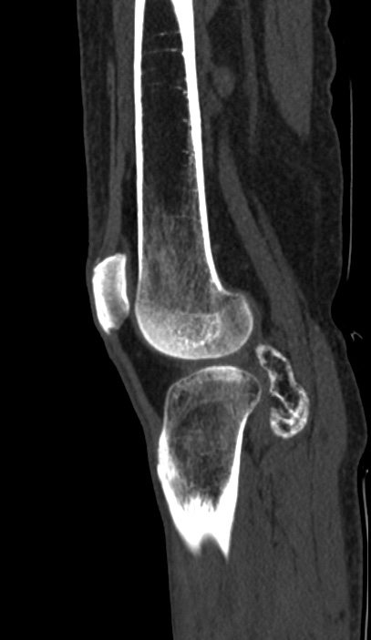 Calcified hematoma - popliteal fossa (Radiopaedia 63938-72763 Sagittal bone window 82).jpg