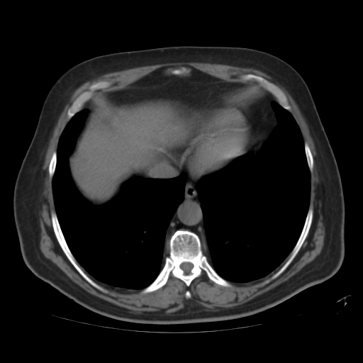 File:Calcified hepatic hydatid cyst (Radiopaedia 18907-18853 Axial non-contrast 2).jpg