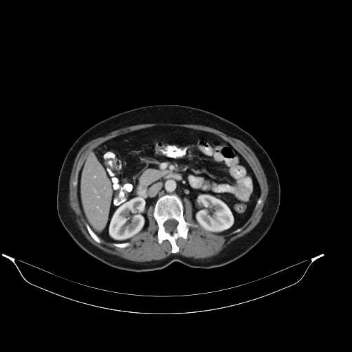File:Calcified hydatid cyst of the liver (Radiopaedia 21212-21112 A 17).jpg