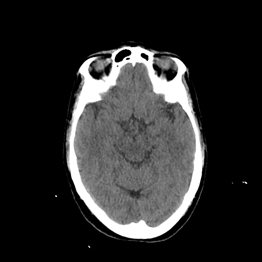File:Calcified meningioma - cervical canal (Radiopaedia 70136-80171 Axial non-contrast 11).jpg