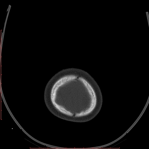 Calcified middle cerebral artery embolism (Radiopaedia 78949-91860 Axial bone window 70).jpg