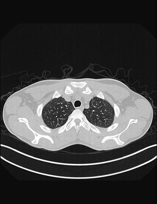 Calcifying pulmonary metastases (Radiopaedia 33359-34396 Axial lung window 11).jpg