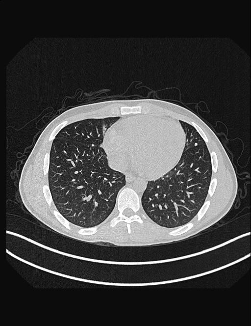 Calcifying pulmonary metastases (Radiopaedia 33359-34396 Axial lung window 44).jpg