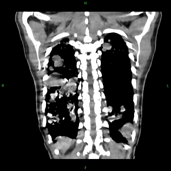 File:Cannon ball metastases - synovial sarcoma (Radiopaedia 26135-26271 Coronal liver window 19).jpg