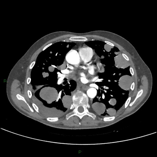 Cannonball metastases (Radiopaedia 82110-96150 Axial C+ CTPA 174).jpg