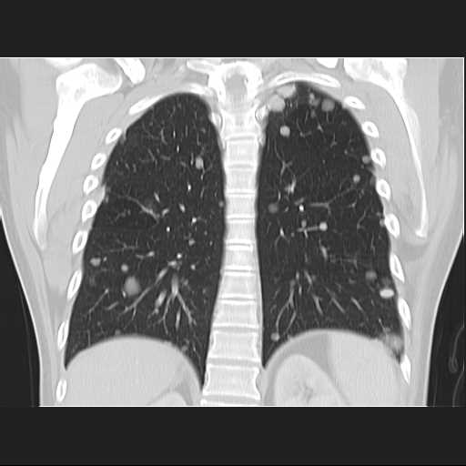 File:Cannonball pulmonary metastases (Radiopaedia 67684-77101 C 18).jpg