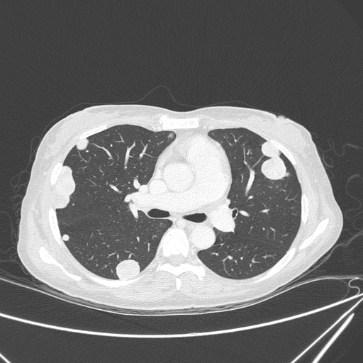 Canonball lung metastasis (Radiopaedia 77634-89837 Axial lung window 79).jpg