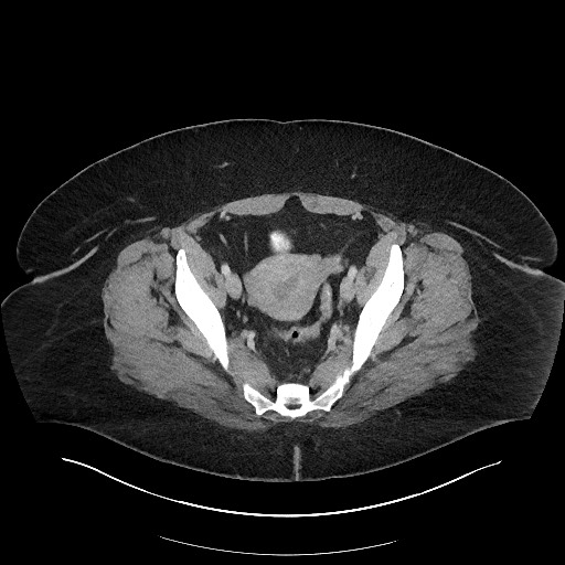 Carcinoid tumor - terminal ileum (Radiopaedia 60931-68739 A 112).jpg