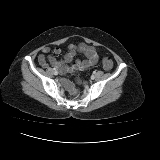 File:Carcinoma colon - hepatic flexure (Radiopaedia 19461-19493 A 102).jpg