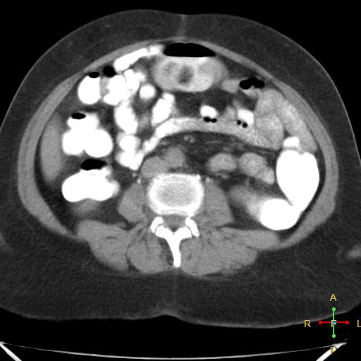 File:Carcinoma of sigmoid colon (Radiopaedia 23071-23100 C+ delayed 11).jpg