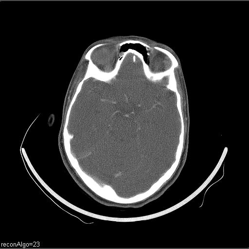 Carcinoma of the maxillary antrum (Radiopaedia 53805-59888 Axial C+ delayed 71).jpg