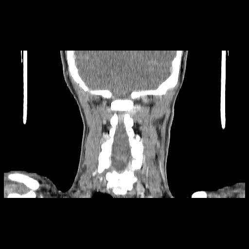 Carcinoma of the maxillary antrum (Radiopaedia 53805-59888 Coronal C+ delayed 129).jpg