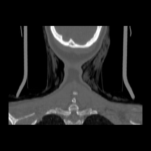 Carcinoma of the maxillary antrum (Radiopaedia 53805-59888 Coronal bone window 146).jpg